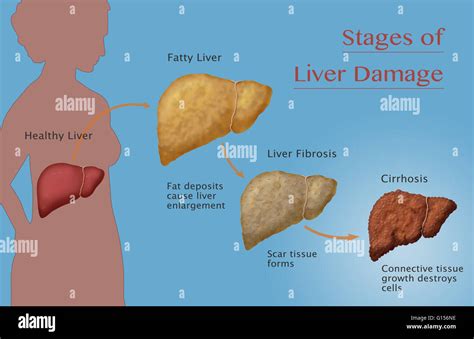 The early identification of alcohol use disorders and liver injury .